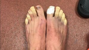 Toes with chilblains