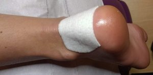 Heel tape to treat blisters