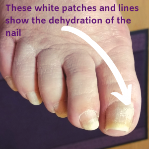 A dehydrated toe nail