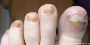 Toes with nail fungus