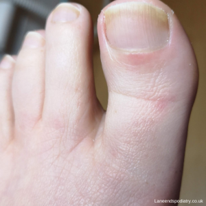 A healthy toe after nail fungus treatment