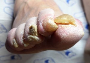 A podiatry patient with thick, bendy problem toenails.