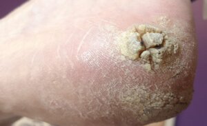 A verruca on a patient's heel