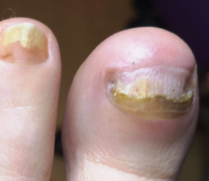 A big toe with nail fungus