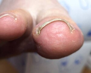 A curved or involuted toenail
