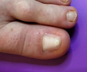 nail after reconstruction