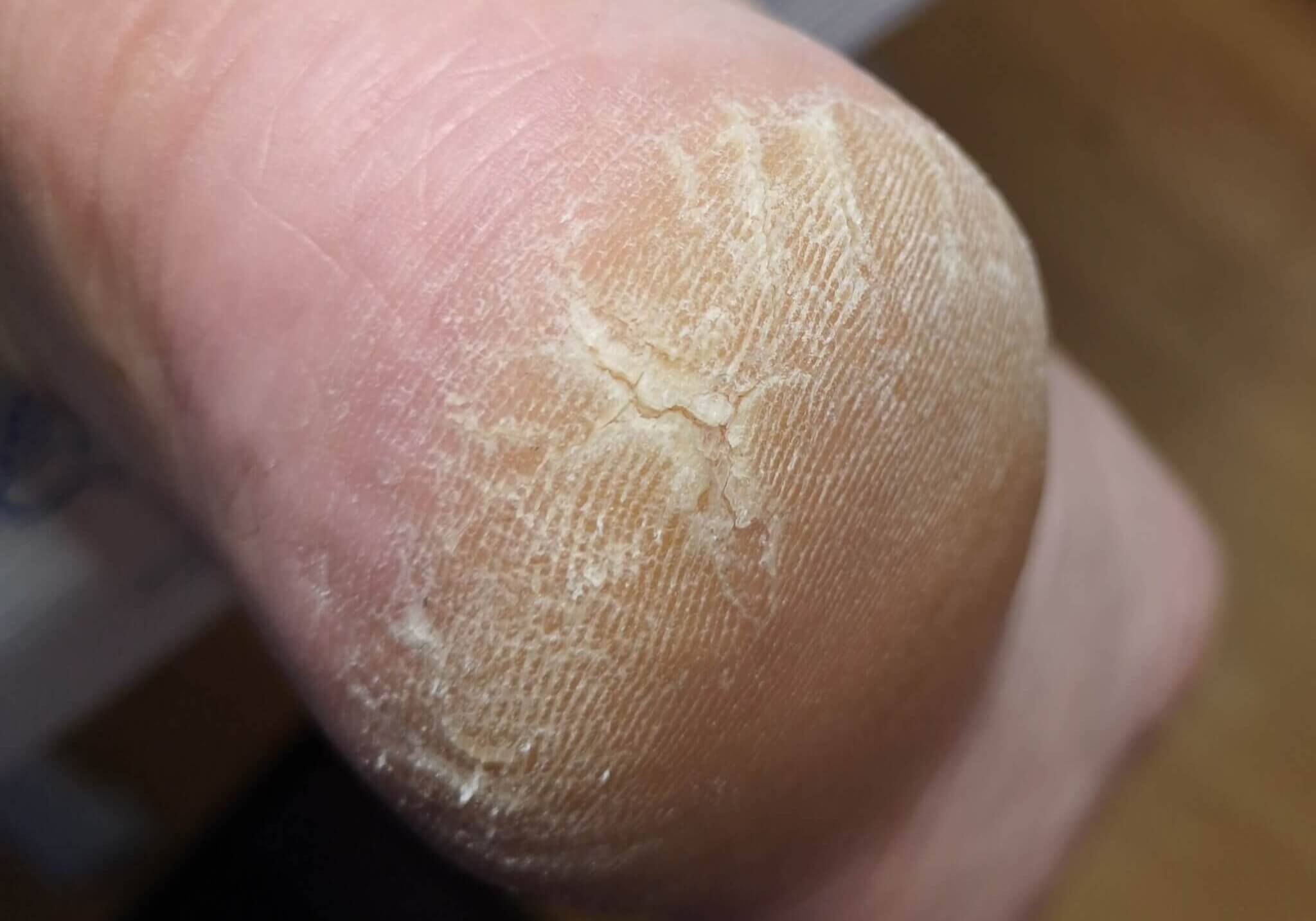 Potty Purple Podiatrist Warrington - cracked heel