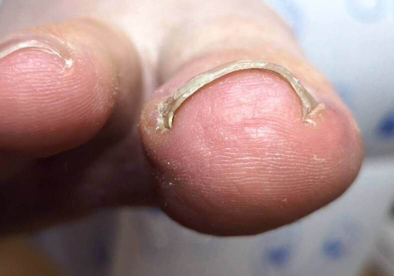 A curved or involuted toenail